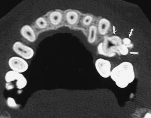 14-year-old girl with compound odontoma in left maxilla.