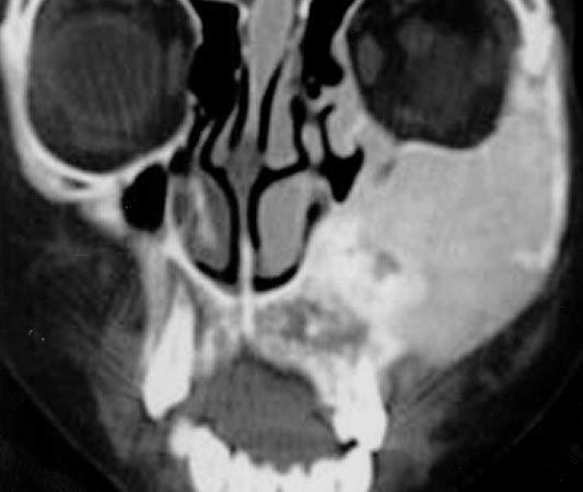 11. 17-year-old girl with monostotic fibrous dysplasia in mandible.