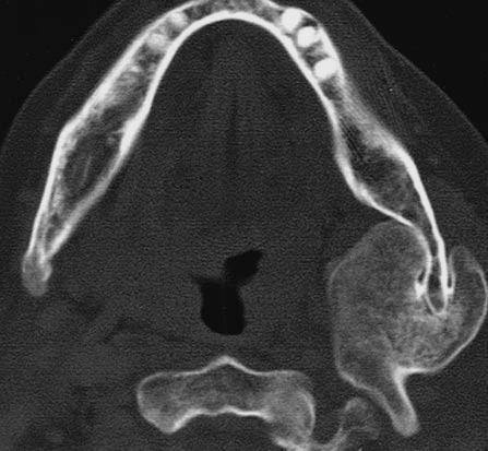 70-year-old woman with osteochondroma of mandible. xial CT scan shows pedunculated mass growing from left mandibular angle.