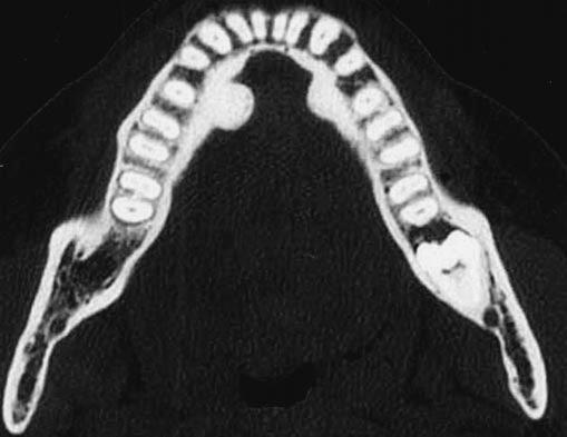 CT of Calcifying Jaw one Diseases Downloaded from www.ajronline.org by 46.3.204.207 on 01/08/18 from IP address 46.3.204.207. Copyright RRS. For personal use only; all rights reserved Fig. 17.