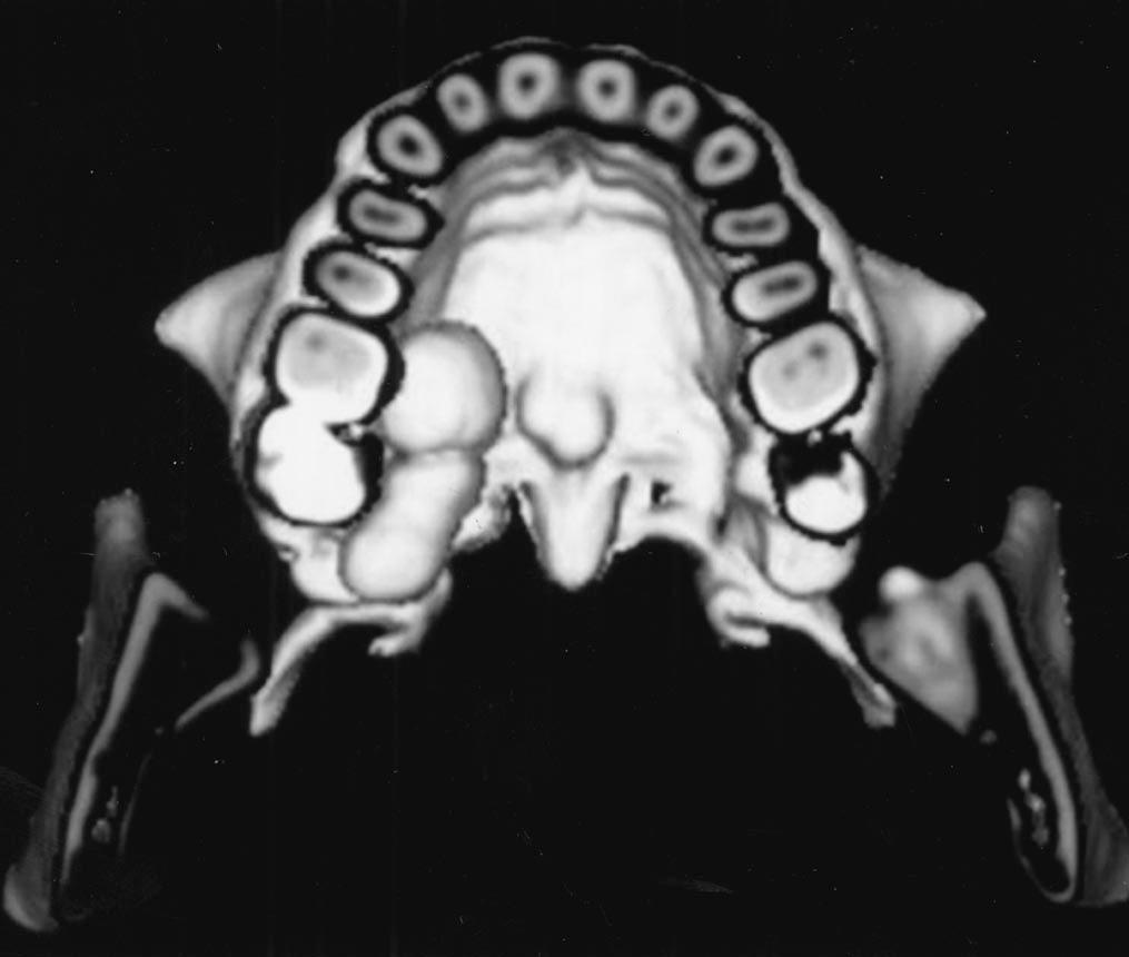 C, xial CT scan shows symmetrical torus mandibularis composed of compact bone.