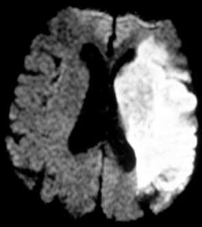 Magnetic Resonance Imaging Diffusion Highly sensitive to acute ischemia DWI + within a few hours!