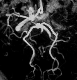 Angiography with