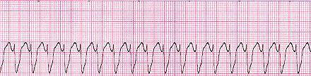 adenosine) ECG No beat-to-beat variation. (Regular RR interval) No clear discernible P waves Almost always narrow QRS complex.