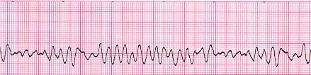 Variable AV conduction from 1:1-4:1. Narrow QRS. Unique for each type. VT Retrograde or no visible P waves. AV dissociation. Wide QRS.