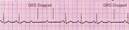 Mobitz type 1 Salient features Never symptomatic Intermittent failure of AV conduction with prior PR prolongation.