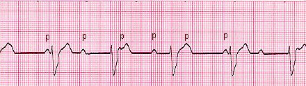 prolongation. Frequently progresses to complete heart block. Not reversible with medications. Worse prognosis than type 1.