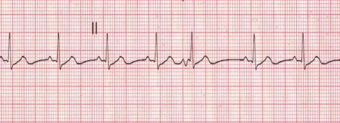 intervention. ECG Prolongation of the PR interval. (>0.15 sec) Progressive prolongation of PR interval until after 3-4 cycles the P wave is not conducted.