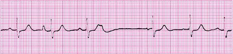 Atrial rate > ventricular rate. (P wave appear regularly at normal rate but not followed by QRS complex, which occurs at a much slower rate.