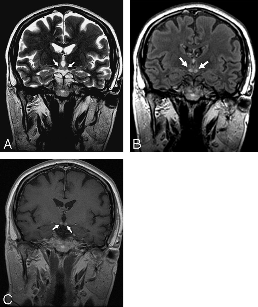 A 53-year-old woman with an history of chronic alcohol abuse presented with the classic neurologic triad of