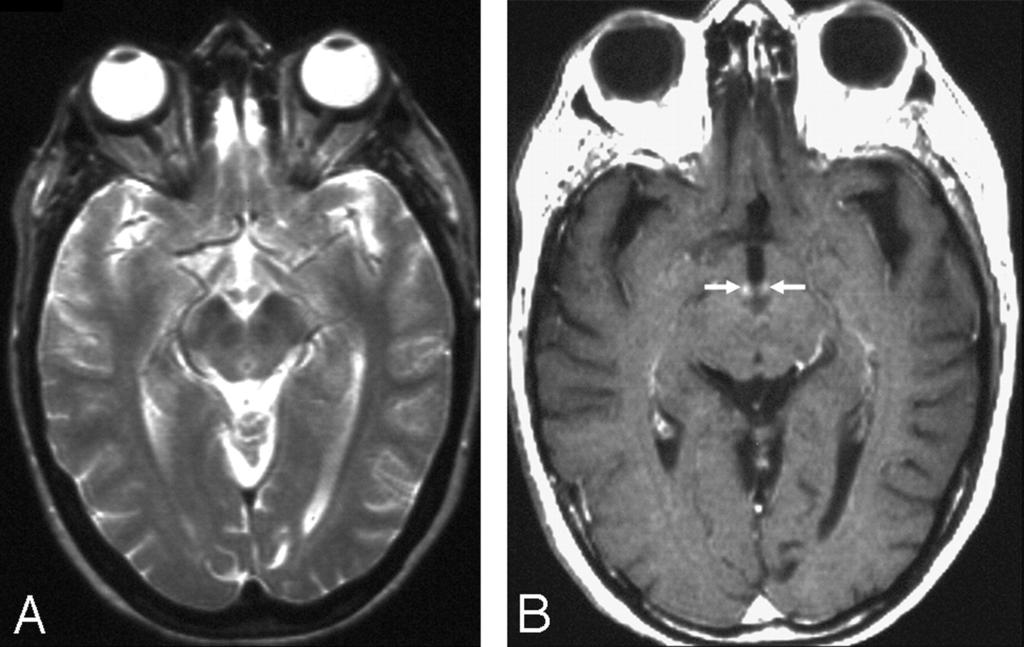 A 45-year-old woman with a history of alcohol abuse had changes in consciousness and ocular abnormalities.