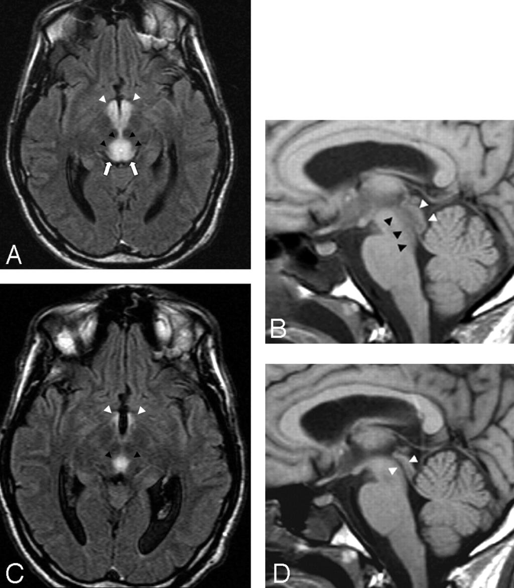 A 33-year-old man presented with sudden and progressive changes in consciousness after prolonged voluntary food starvation.