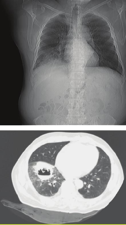 Case Reports in Medicine 3 Figure 4: Rapid, major pulmonary infiltration by day six of admission.