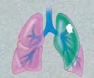 Surgery may be done for other conditions, as well, such as a collapsed lung or fluid around the lung.