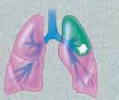 A Collapsed Lung If a portion of the lung is thin or ruptured, air may leak into the pleural cavity (the space between the lungs and the chest wall).
