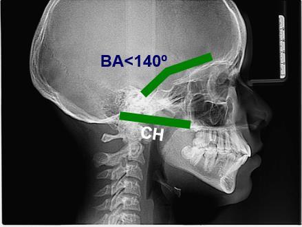 occipito-atloid-axoid angle junction, are other parameters that must be determined in the images of the craniocervical region, of which normal value is between 115-140 and 125, respectively (Fig.