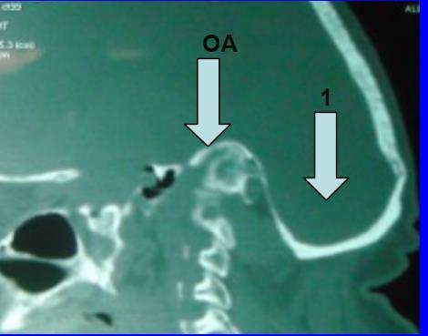 OA: lateral continuity of the atlas and occipital is appreciated.