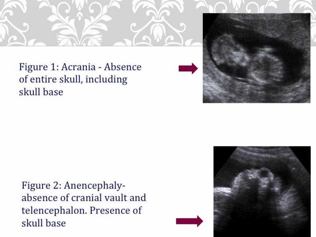 Fig. 8: Images showing acrania