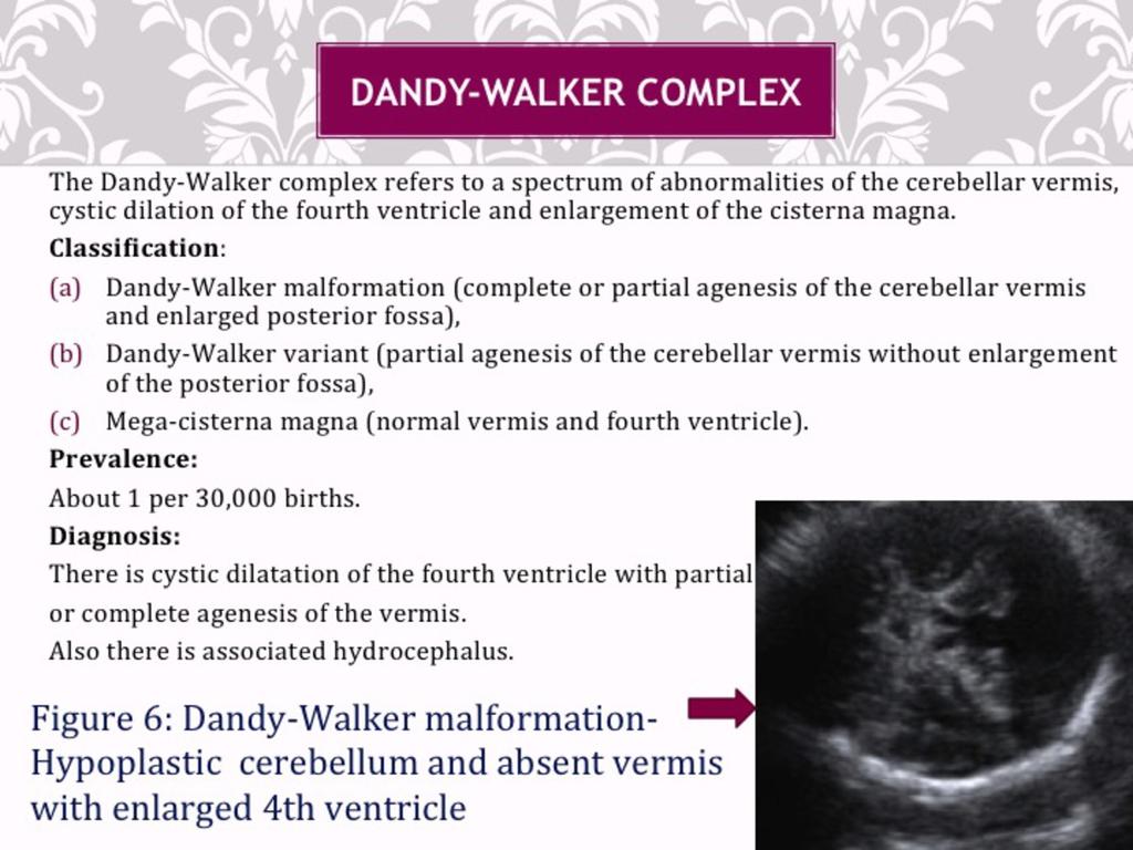 Fig. 11: Dandy-Walker complex