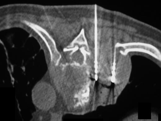 , T scan shows two infused 18-gauge radiofrequency needles that were inserted into paravertebral mass under T and fluoroscopic guidance.