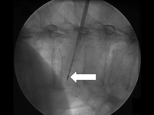 inserted through the 10-gauge needle (arrow). D, T and fluoroscopic control image after radiofrequency plus vertebroplasty shows oval paraspinal necrotic area, with cement in vertebral body.