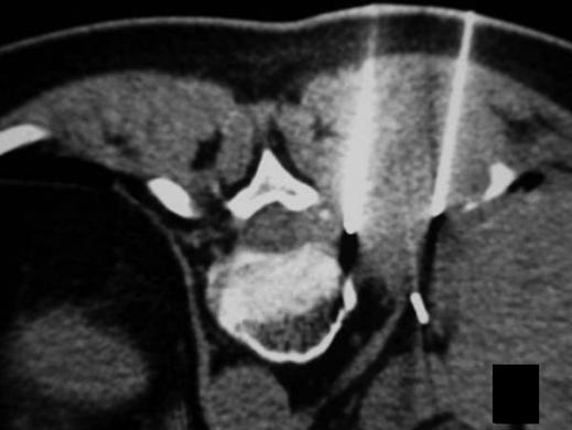 , T scan shows left paraspinal soft-tissue lesion, with involvement of ipsilateral pedicle and posterior arc of ipsilateral rib.