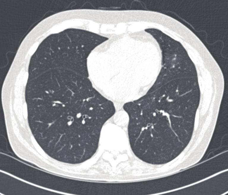 normal lower lung zones (Figure 3A) demonstrating marked bronchial wall thickening, bronchiectasis and tree-in-bud nodularity (Figure 3B).