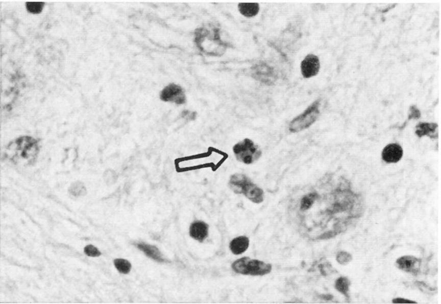 2 LAMARIVAN SICKLE._.i - Fig 1. Clumps of chromatin (arrow) in the spinal cord of a pig with congenital tremor. HE. count, was done on each of the control animals.