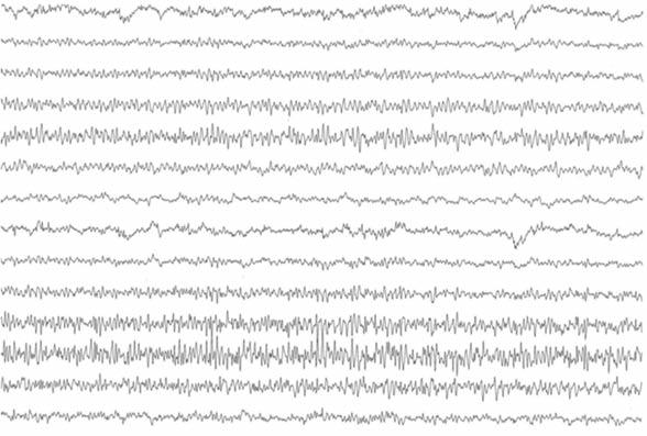 Recurrent occipital seizures and status migrainosus 70 µv 1 sec Figure 2. The same ictal EEG recording as in Figure 1, 30 seconds later.