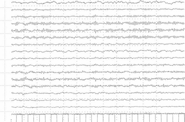 EEG normalization after administration of i.v. diazepam. migraine with aura from occipital seizures with periictal headache.
