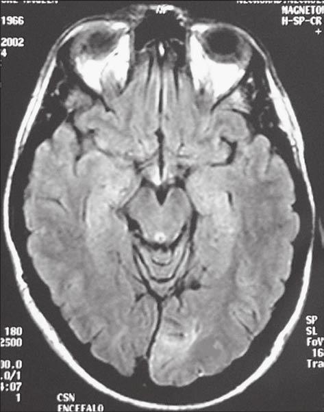 D. Italiano, et al. Figure 4. Brain MRI, axial FLAIR image: hyperintense signal area in left occipital cortico-subcortical regions (see arrow). Figure 5.