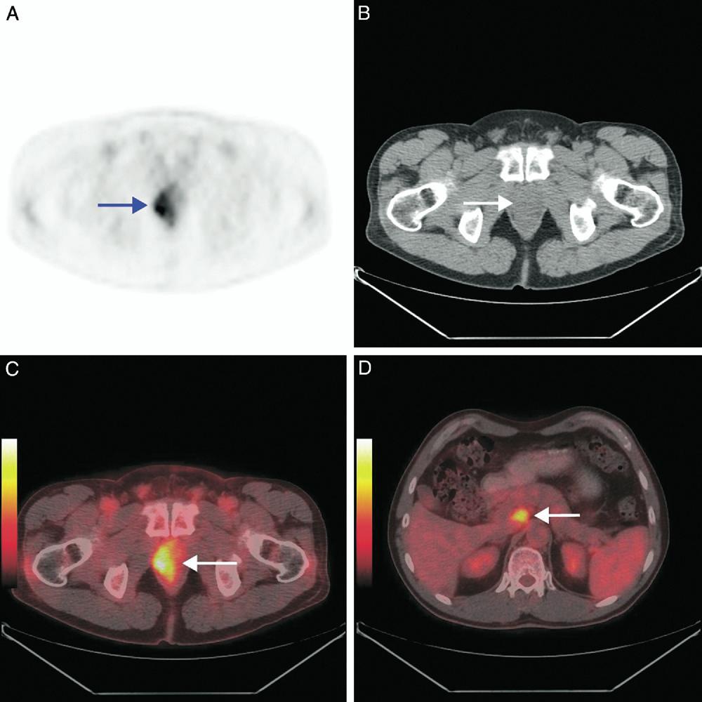 36 POSITRON EMISSION TOMOGRAPHY/COMPUTERIZED TOMOGRAPHY FIG. 1. Staging in 56-year-old man with prostate cancer and serum PSA 61 ng/ml. No metastases were found on conventional bone scintigraphy.