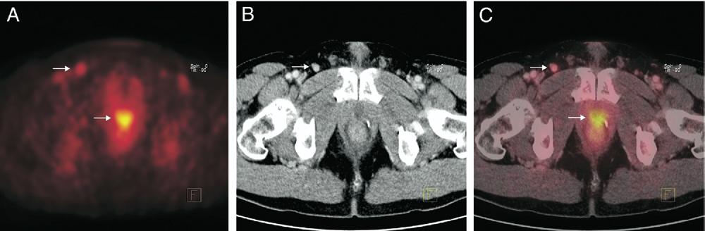 38 POSITRON EMISSION TOMOGRAPHY/COMPUTERIZED TOMOGRAPHY FIG. 2. Prostate cancer recurrence in 56-year-old man with history prostatectomy and later radiation therapy because of increasing PSA.