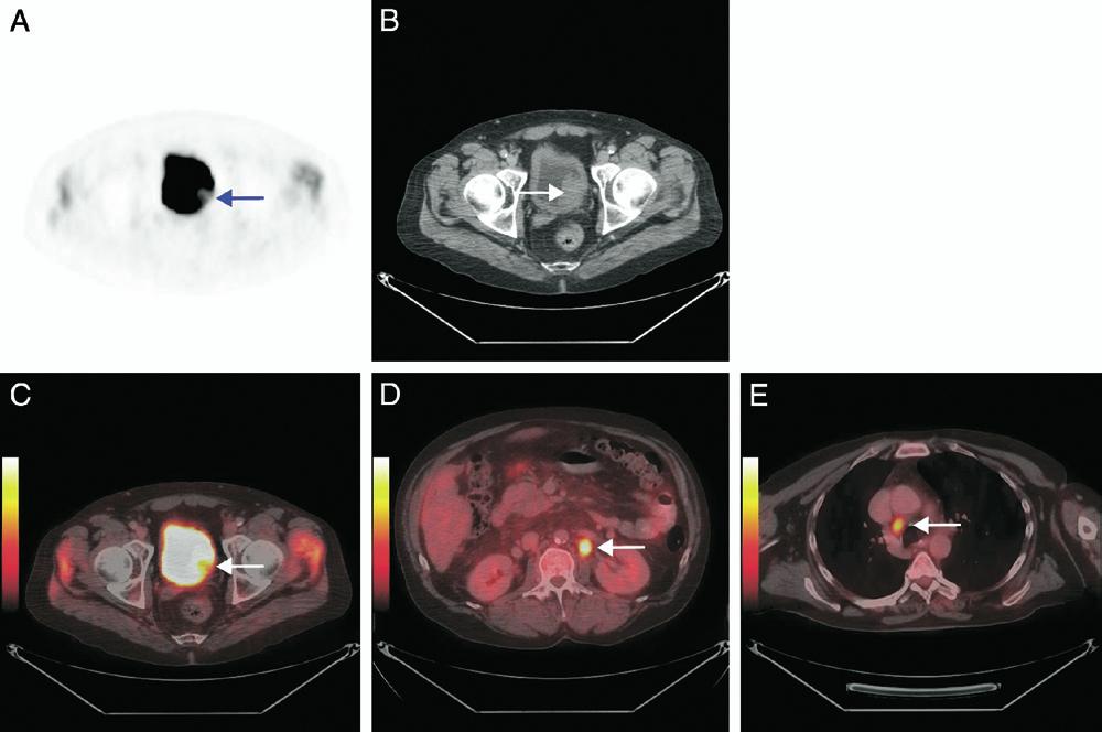 POSITRON EMISSION TOMOGRAPHY/COMPUTERIZED TOMOGRAPHY 41 FIG. 3. Unknown primary tumor and bladder cancer staging in 54-year-old man with tumor on right side of neck.