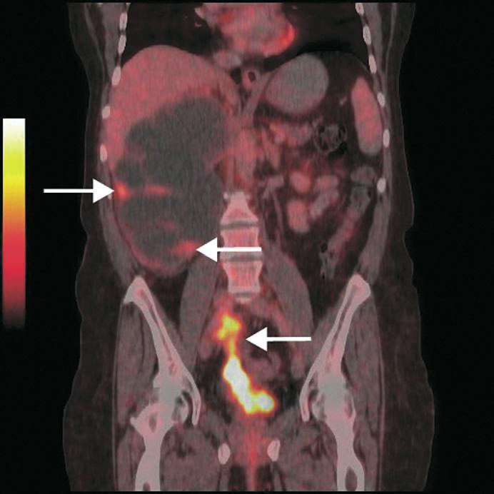 Axial PET/CT fusion images reveal foci with tracer accumulations in retroperitoneal and mediastinal lymph nodes (D and E).