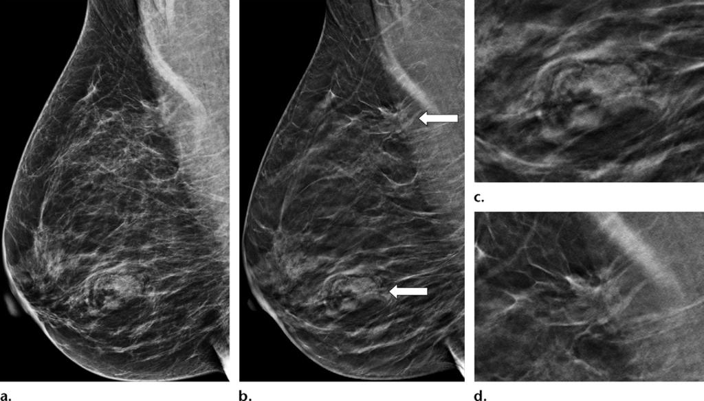 1960 November-December 2016 radiographics.rsna.org Figure 5. Interval cancer at DBT. (a) CC DBT image obtained at routine screening (left) was interpreted as negative.