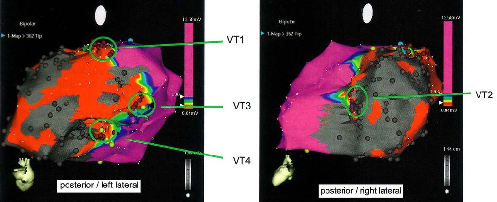Risk of SD after sustained VT VT ablation is a good alternative therapy for idiopathic VT