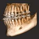 (Temporomandibular Joint) work or full dentition examination and implant