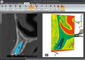 NIP*: PERFECT FOR IMPLANT WORK CINEX : DYNAMIC IMAGES NewTom Implant Planning NewTom Implant Planning is a software package that allows 3D