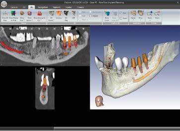 This software can simulate positioning of an implant on 2D and 3D models, identifying the mandibular canal, producing panoramics and cross