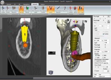 The software is used for the fast, safe and efficient design of prostheses for implant work.