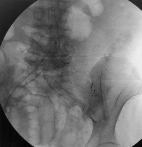 Branches of the superior mesenteric artery were embolized in 12 patients, branches of the inferior mesenteric artery were embolized in 12 patients, and branches of both the superior and inferior