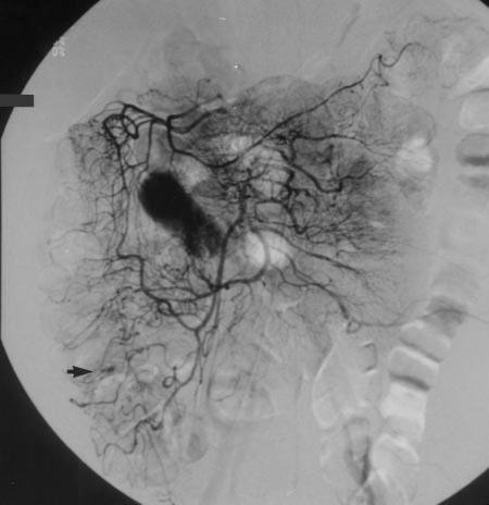 Embolization was performed only when the catheter could be advanced to or distal to the mesenteric border of the colon (in other words, to the marginal artery or vasa rectae). Microcoils (complex Fig.