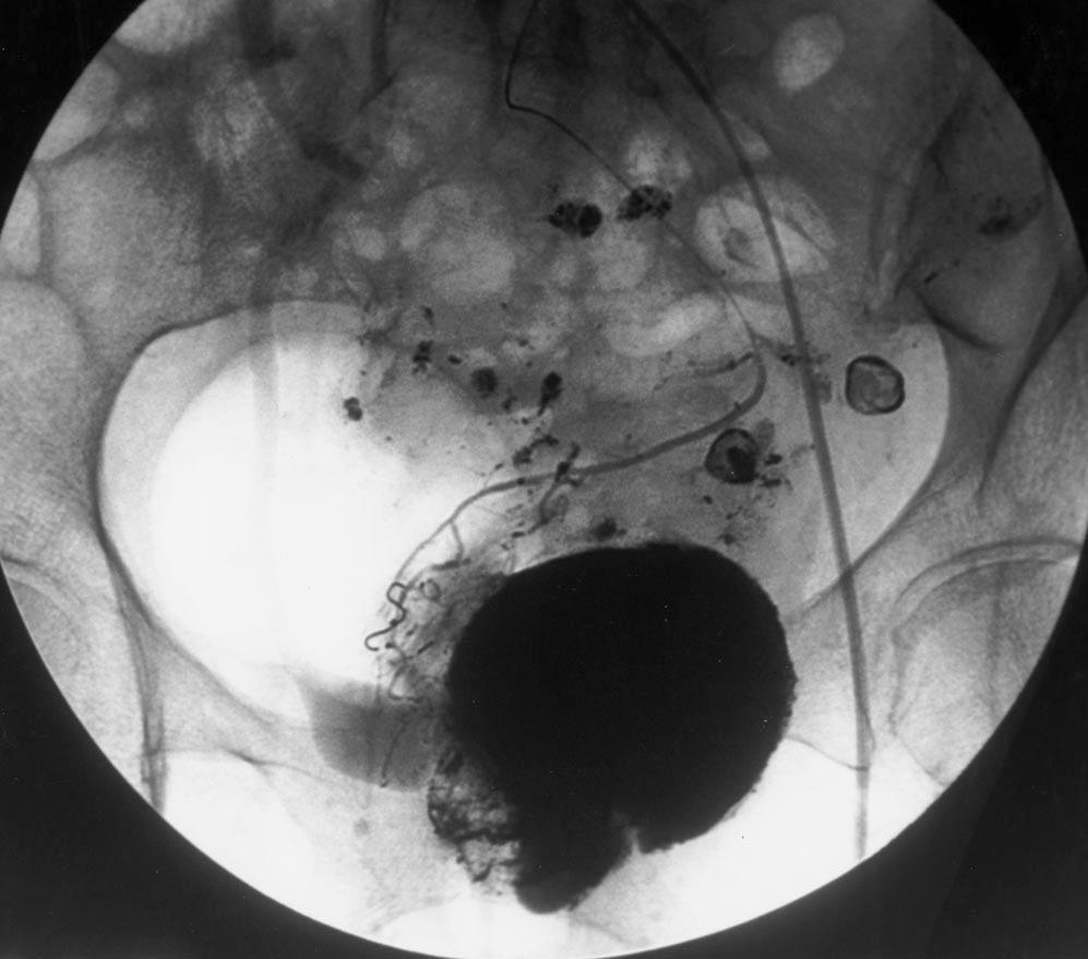 Microcoil Embolization of Colonic Hemorrhage Fig. 4. Microcoil embolization in 84-year-old woman with rectal barium impaction performed after failed colonoscopy.