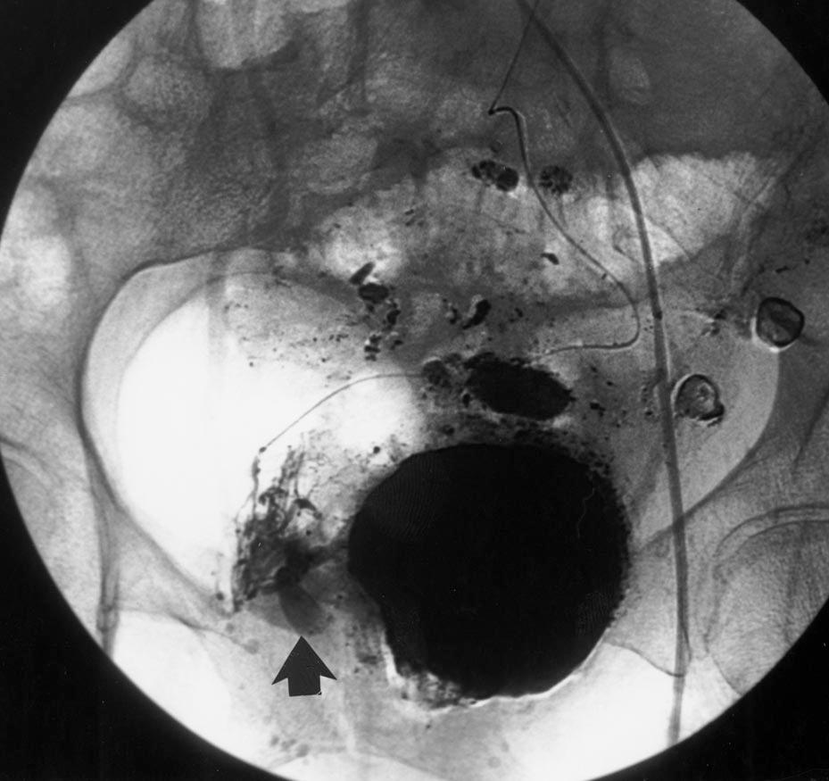 B, Superselective arteriogram through microcatheter shows active hemorrhage from left rectum (arrow). C, Repeated superselective arteriogram after embolization shows no further hemorrhage.