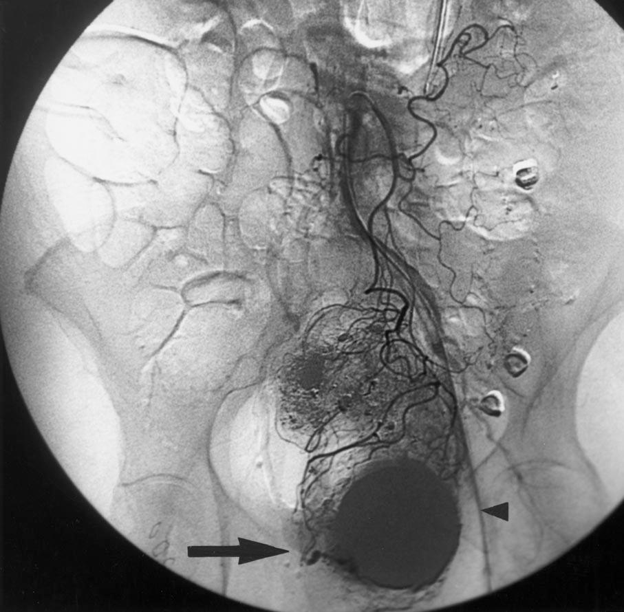 been ischemic in nature. A colonic stricture detected at colonoscopy developed in one patient 1 year after successful embolization. Major ischemic complications occurred in two patients.