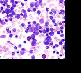 Chronic Myeloid Leukemia (CML) 15% of adult leukemia 1) Chronic Phase (excess white blood cells