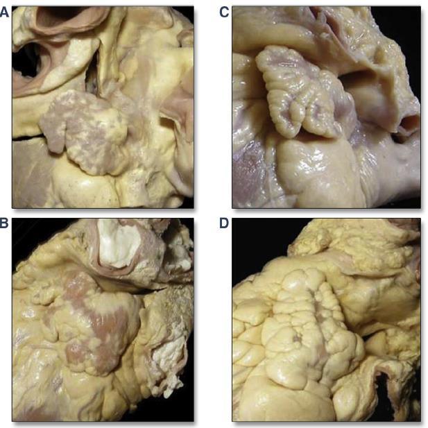 The Left Atrial Appendage: Anatomy, Function, and Noninvasive Evaluation.