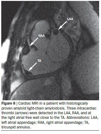 LAA Thrombus in Sinus Rhythm High-risk factors identified Significant left-sided VHD Severe LV dysfunction Previous