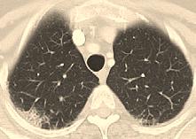 Bleomycin Bleomycin induced pulmonary toxicity Presents 1-6 months after